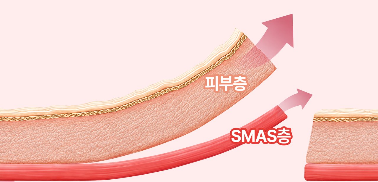듀얼 플레인 — 피부층 · SMAS층