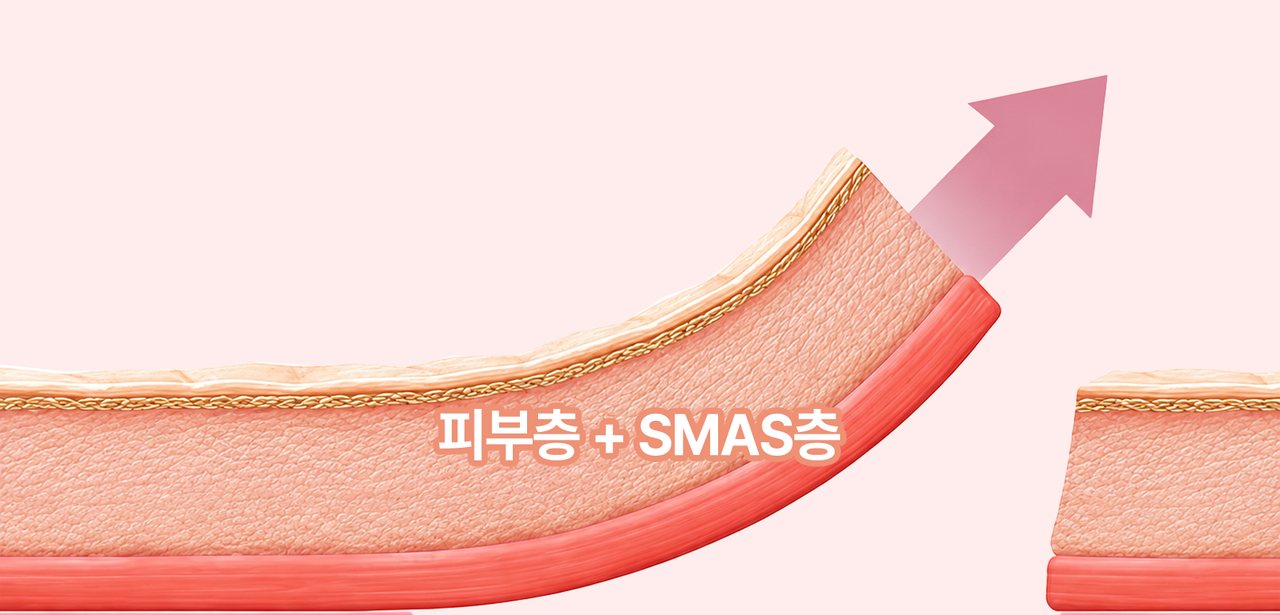 익스텐디드 딥 플레인 — 피부층 + SMAS층