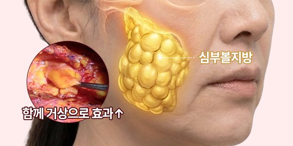 심부볼까지 거상해야 리프팅이 오래갑니다. — 심부볼지방 · 함께 거상으로 효과↑
