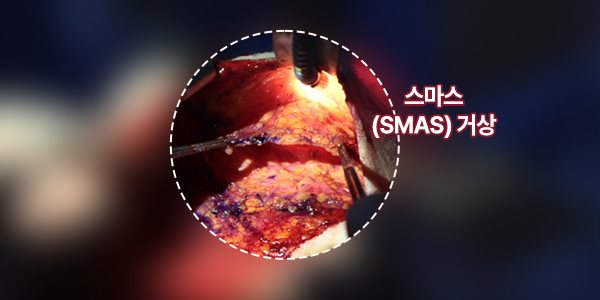 오래가는 리프팅은 고정 방식이 다릅니다. — 스마스 · (SMAS) 거상