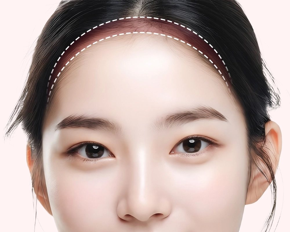정면 여성 이마 — 헤어라인을 따라 두 줄 점선(내시경 이마거상 부위)